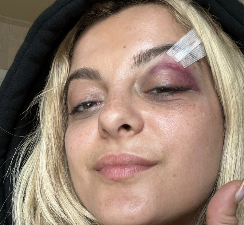 Bebe Rexha Shows Fans Her Injury After Being Struck by Cellphone During NYC Concert [Photos]