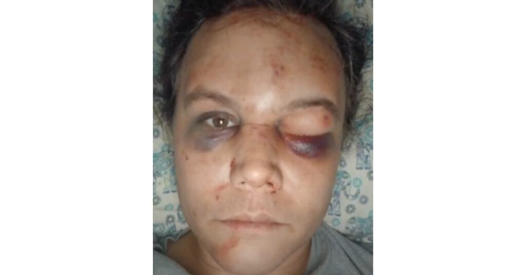 Nikki Armstrong after the attack